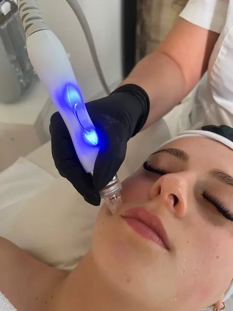 Dermapen tretman